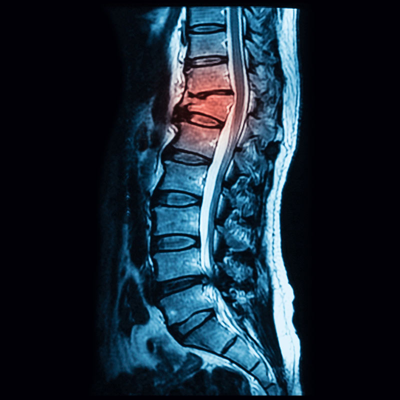 Querschnitt der Wirbelsäule von einem Röntgengerät betrachtet. Schmerzquellen sind rot dargestelllt.jpg