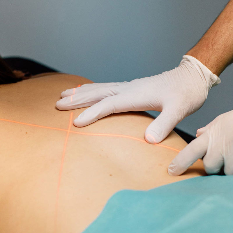 Transforaminal-epidurale Infiltration